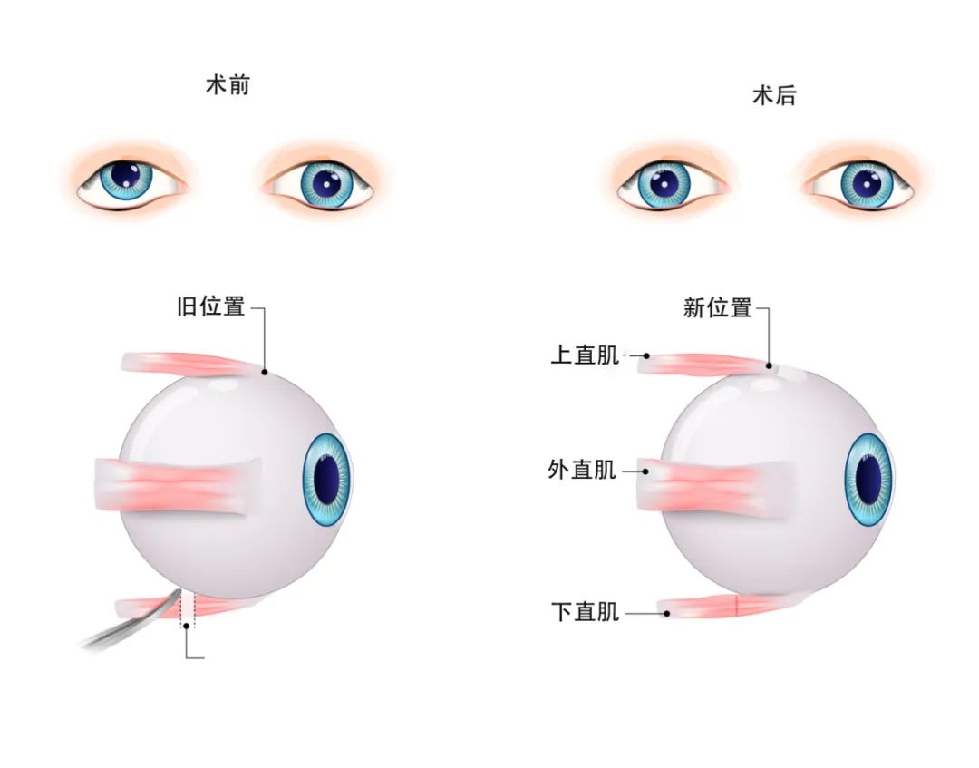 斜弱視認識誤區,父母必須知道的斜弱視知識 斜弱視認識誤區,父母必須知道的斜弱視知識