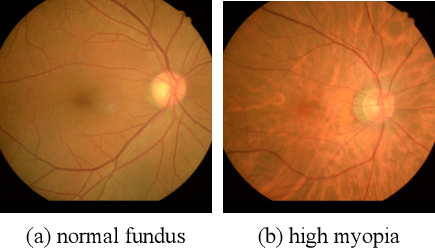 近視度數高的人,近視導致眼底裂了 近視度數高的人,近視導致眼底裂了