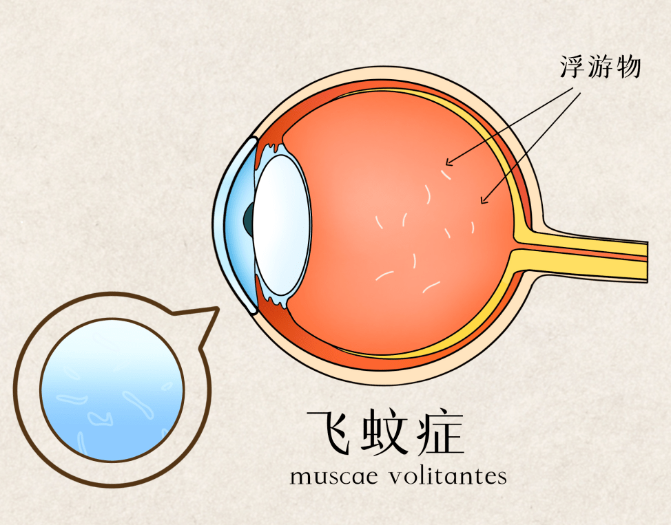 玻璃體渾濁示意圖