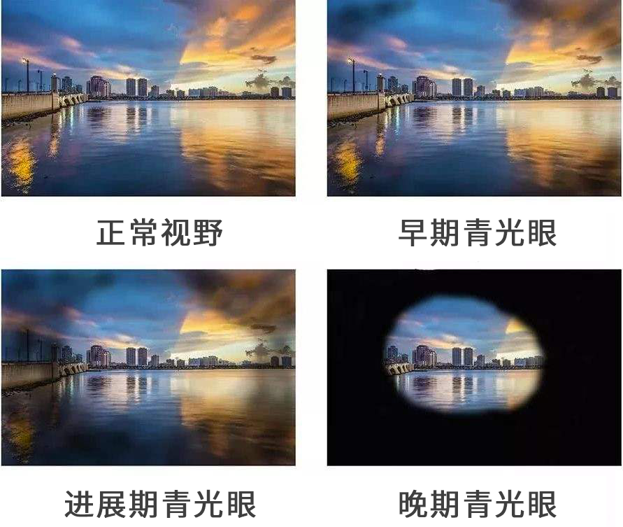 青光眼不同時期的示意圖