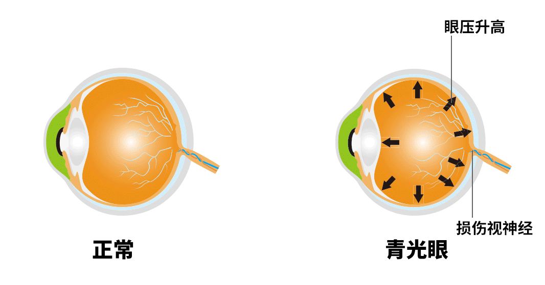 青光眼有哪些癥狀