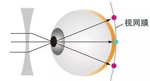 離焦眼鏡,離焦眼鏡原理,青少年近視防控 離焦眼鏡,離焦眼鏡原理,青少年近視防控