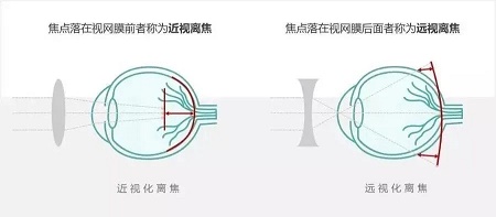 離焦眼鏡,離焦眼鏡原理,青少年近視防控 離焦眼鏡,離焦眼鏡原理,青少年近視防控