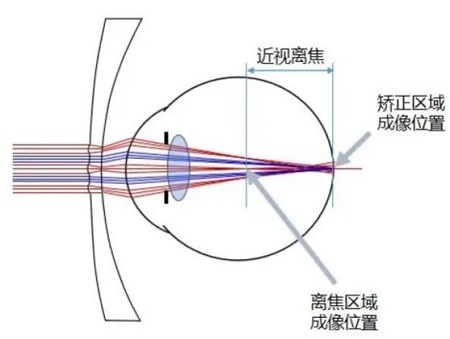 離焦眼鏡,離焦眼鏡原理,青少年近視防控 離焦眼鏡,離焦眼鏡原理,青少年近視防控