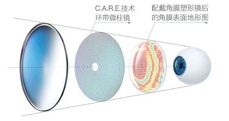 離焦眼鏡,離焦眼鏡原理,青少年近視防控 離焦眼鏡,離焦眼鏡原理,青少年近視防控