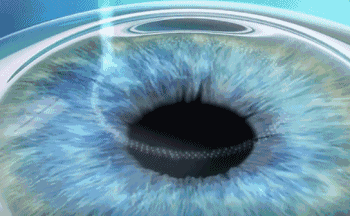 珠海全飛秒近視手術,全飛秒近視手術去哪家醫院好 珠海全飛秒近視手術,全飛秒近視手術去哪家醫院好