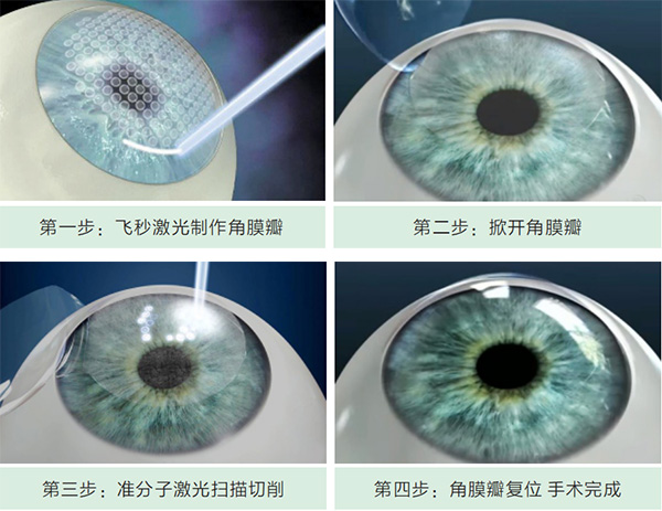 全飛秒,技術,升級,切口,更小,更,穩定,眼睛,是, 全飛秒,技術,升級,切口,更小,更,穩定,眼睛,是,