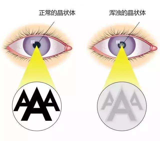 白內障,手術,之后,“,復發,”,了,醫生,說, 白內障,手術,之后,“,復發,”,了,醫生,說,