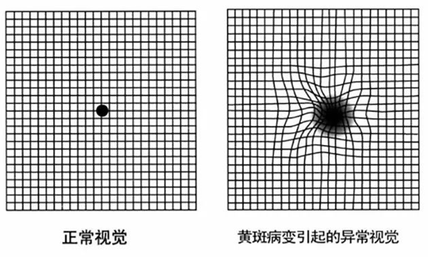黃斑前膜,黃斑裂孔,黃斑劈裂,黃斑變性