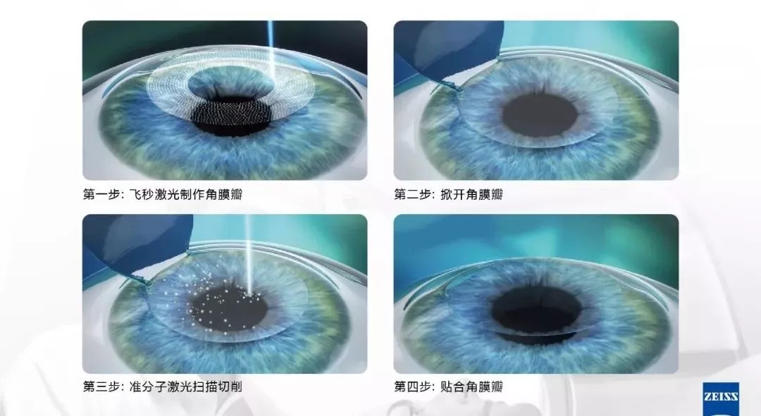 近視手術,激光矯正,晶體植入式,珠海?，斞劭漆t