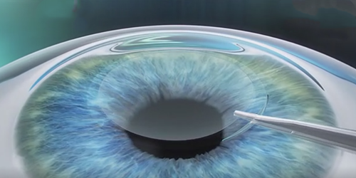 全飛秒,半飛秒,ICL,珠海希瑪眼科醫院 全飛秒,半飛秒,ICL,珠海希瑪眼科醫院