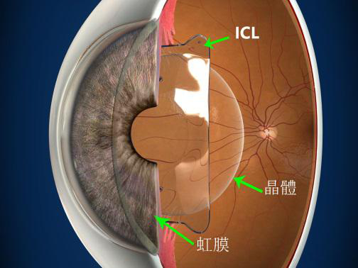 全飛秒,半飛秒,ICL,珠海希瑪眼科醫院 全飛秒,半飛秒,ICL,珠海希瑪眼科醫院