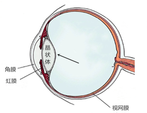 白內障,視力模糊,色覺異常,老花眼,單眼復視,珠海 白內障,視力模糊,色覺異常,老花眼,單眼復視,珠海