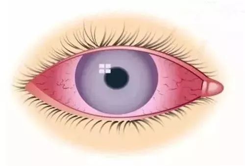 青少年近視,兒童近視,OK鏡,珠海希瑪眼科醫院