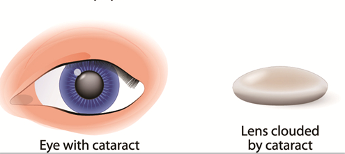 白內障,老花眼,珠海希瑪眼科 白內障,老花眼,珠海希瑪眼科