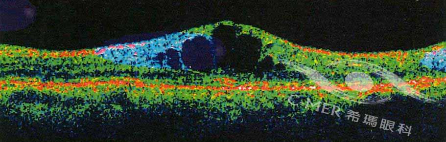 黃斑水腫,治療,希瑪,眼科,病癥,糖尿病,黃斑,林順 黃斑水腫,治療,希瑪,眼科,病癥,糖尿病,黃斑,林順