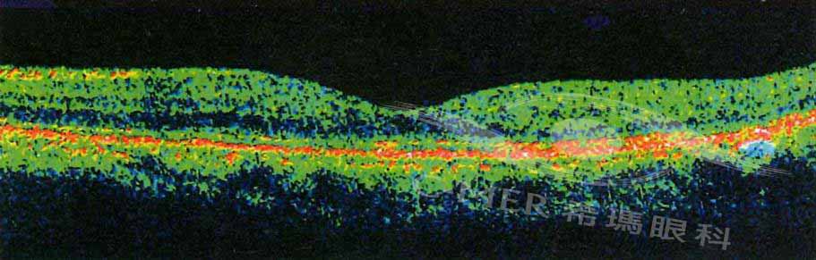 黃斑水腫,治療,希瑪,眼科,病癥,糖尿病,黃斑,林順 黃斑水腫,治療,希瑪,眼科,病癥,糖尿病,黃斑,林順