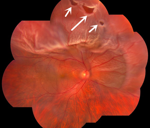 高度近視,屈光,近視,珠海希瑪眼科 高度近視,屈光,近視,珠海希瑪眼科