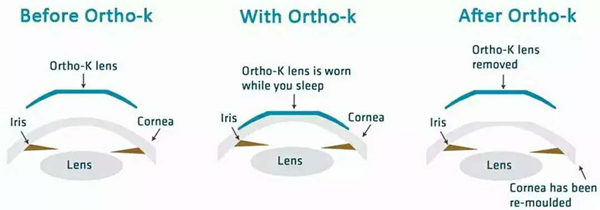 近視,治療近視，近視手術(shù)，珠海?，斞劭漆t(yī)院
