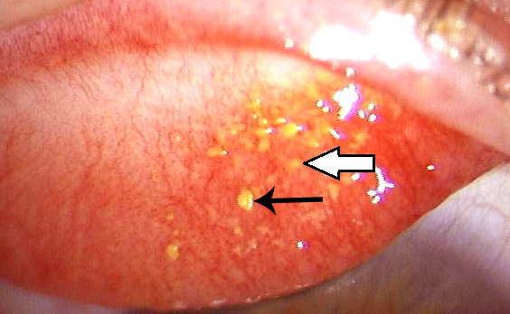 眼結(jié)石,結(jié)石病變,珠海希瑪眼科醫(yī)院 眼結(jié)石,結(jié)石病變,珠海希瑪眼科醫(yī)院