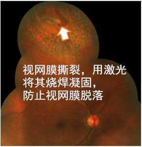 飛蚊,病癥,玻璃體,視網膜,珠海希瑪眼科醫院