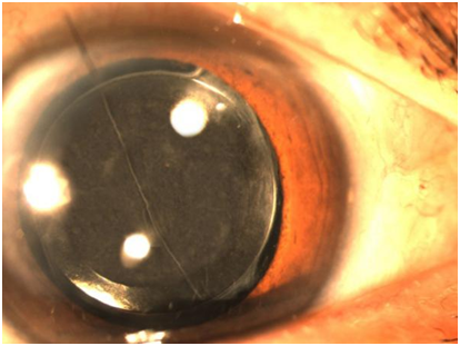 白內(nèi)障,人力,出現(xiàn),白內(nèi)障手術(shù),手術(shù)治療 白內(nèi)障,人力,出現(xiàn),白內(nèi)障手術(shù),手術(shù)治療