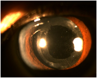 白內(nèi)障,人力,出現(xiàn),白內(nèi)障手術(shù),手術(shù)治療 白內(nèi)障,人力,出現(xiàn),白內(nèi)障手術(shù),手術(shù)治療