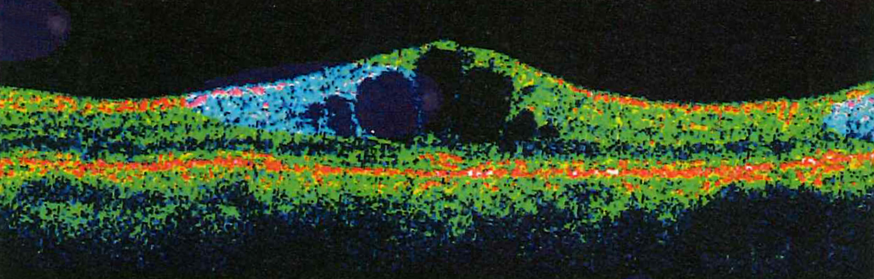視網(wǎng)膜脫離,白內(nèi)障,青光眼,眼球萎縮,珠海希瑪眼 視網(wǎng)膜脫離,白內(nèi)障,青光眼,眼球萎縮,珠海希瑪眼