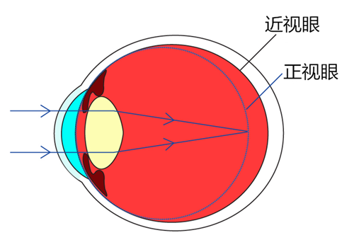 近視眼,眼睛疲勞,用眼過度,珠海希瑪眼科醫院 近視眼,眼睛疲勞,用眼過度,珠海希瑪眼科醫院
