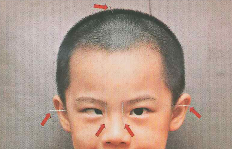 內斜視,屈光,斜視治療,珠海希瑪眼科醫院 內斜視,屈光,斜視治療,珠海希瑪眼科醫院