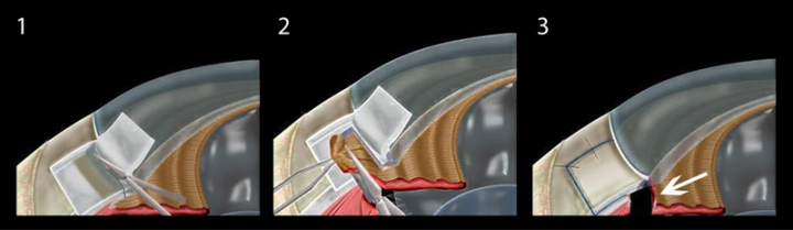 青光眼,高度近視患者,用眼過度,珠海希瑪眼科 青光眼,高度近視患者,用眼過度,珠海希瑪眼科