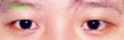 斜視,小兒斜視,治療斜視,珠海希瑪眼科醫院