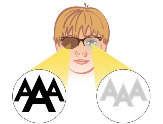 重視,屈光,矯正近視,珠海眼科醫(yī)院 重視,屈光,矯正近視,珠海眼科醫(yī)院