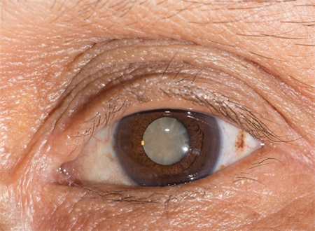 白內(nèi)障,白內(nèi)障的癥狀,白內(nèi)障手術(shù),珠海希瑪眼科