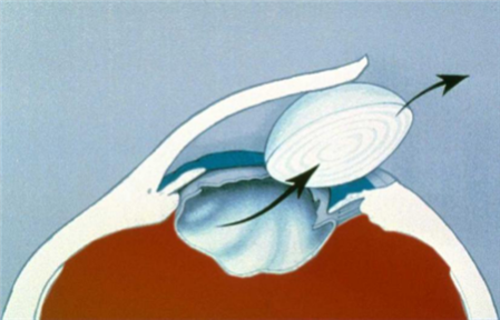 白內障,白內障手術,飛秒白內障手術,珠海希瑪眼科醫院