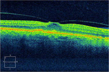 葡萄膜炎,紅眼病,視力下降,珠海?，斞劭漆t院