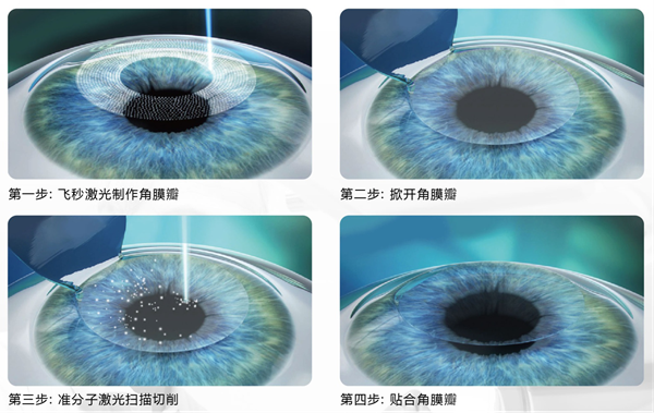 屈光手術,半飛秒激光,全飛秒激光,準分子激光,珠 屈光手術,半飛秒激光,全飛秒激光,準分子激光,珠