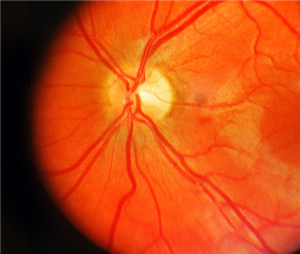 黃斑,視力下降,黃斑變性,老年黃斑,珠海希瑪眼科 黃斑,視力下降,黃斑變性,老年黃斑,珠海希瑪眼科