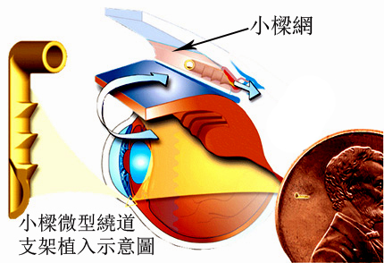 青光眼,失明性眼睛疾病,珠海希瑪眼科 青光眼,失明性眼睛疾病,珠海希瑪眼科