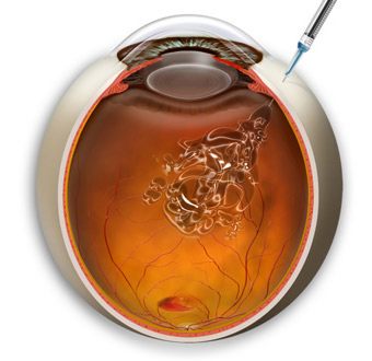 視網膜病變,糖尿病患者,網膜病變,珠海希瑪眼科 視網膜病變,糖尿病患者,網膜病變,珠海希瑪眼科