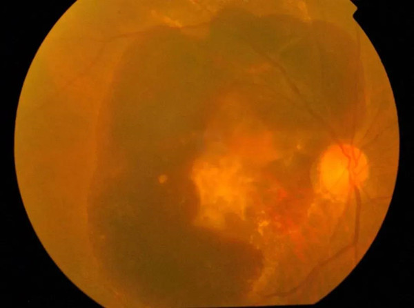 黃斑變性,黃斑前膜,黃斑裂孔,黃斑劈裂,珠海希瑪 黃斑變性,黃斑前膜,黃斑裂孔,黃斑劈裂,珠海希瑪