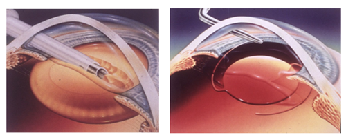 白內(nèi)障,白內(nèi)障手術,珠海希瑪眼科 白內(nèi)障,白內(nèi)障手術,珠海希瑪眼科