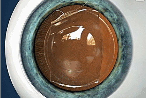 近視,治療近視,近視手術(shù),珠海希瑪眼科醫(yī)院