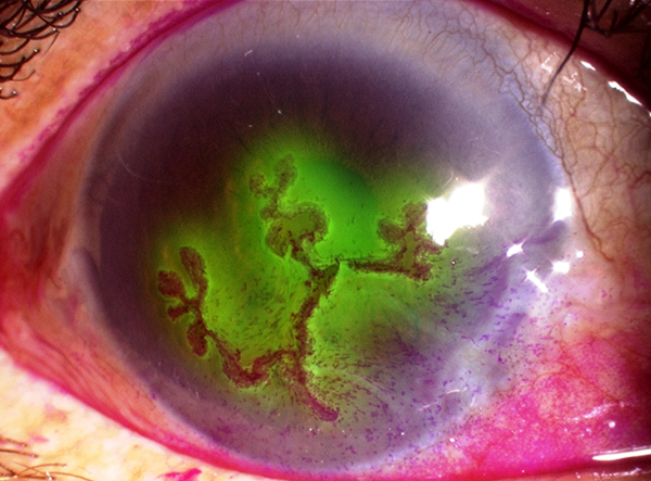 角膜炎,珠海希瑪眼科醫院