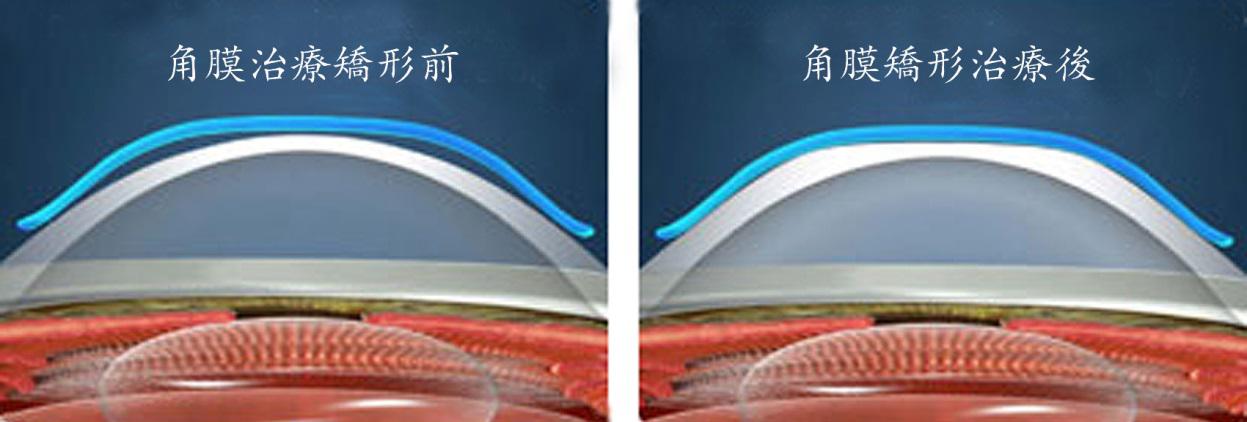 OK鏡,珠海OK鏡,珠海希瑪眼科醫(yī)院