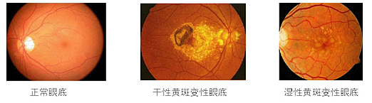 黃斑變性,黃斑水腫,珠海希瑪眼科醫院