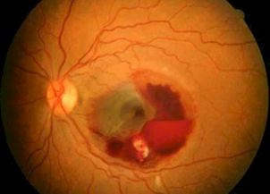 黃斑變性,黃斑病變,黃斑病,珠海希瑪眼科醫院