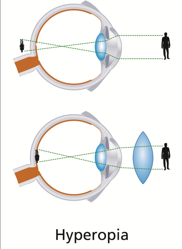 老花眼,老花眼鏡,手術治療老花眼,珠海希瑪眼科醫院