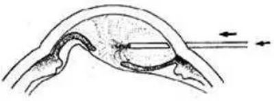 青光眼,急性青光眼,治療青光眼,珠海?，斞劭漆t(yī)院