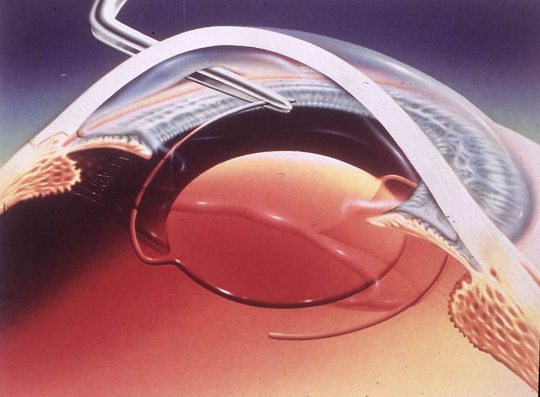 白內障,白內障手術,珠海希瑪眼科醫院